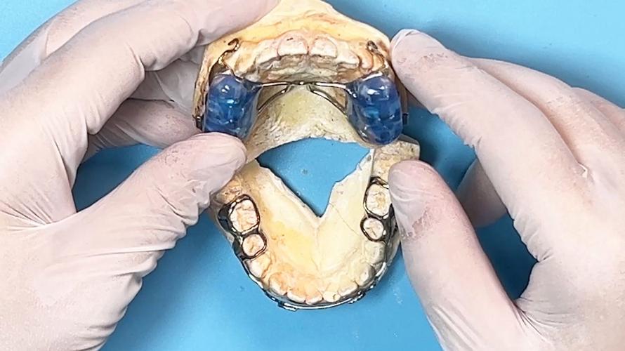 口腔正畸牵引装置视频演示了什么操作？-图3