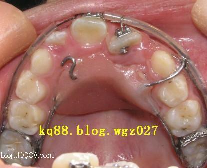 磨牙扭转90度，正畸矫正能恢复正常吗？-图1