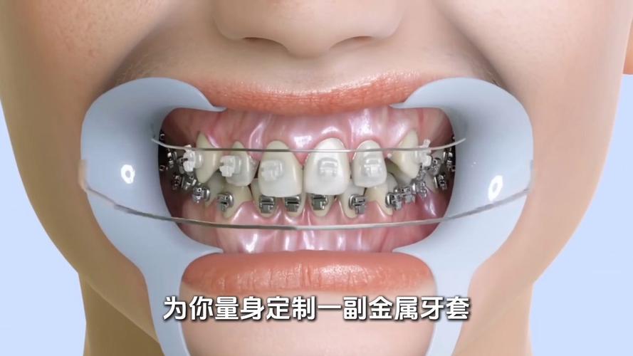 如何正确佩戴隐形牙套？步骤和方法是什么？-图2