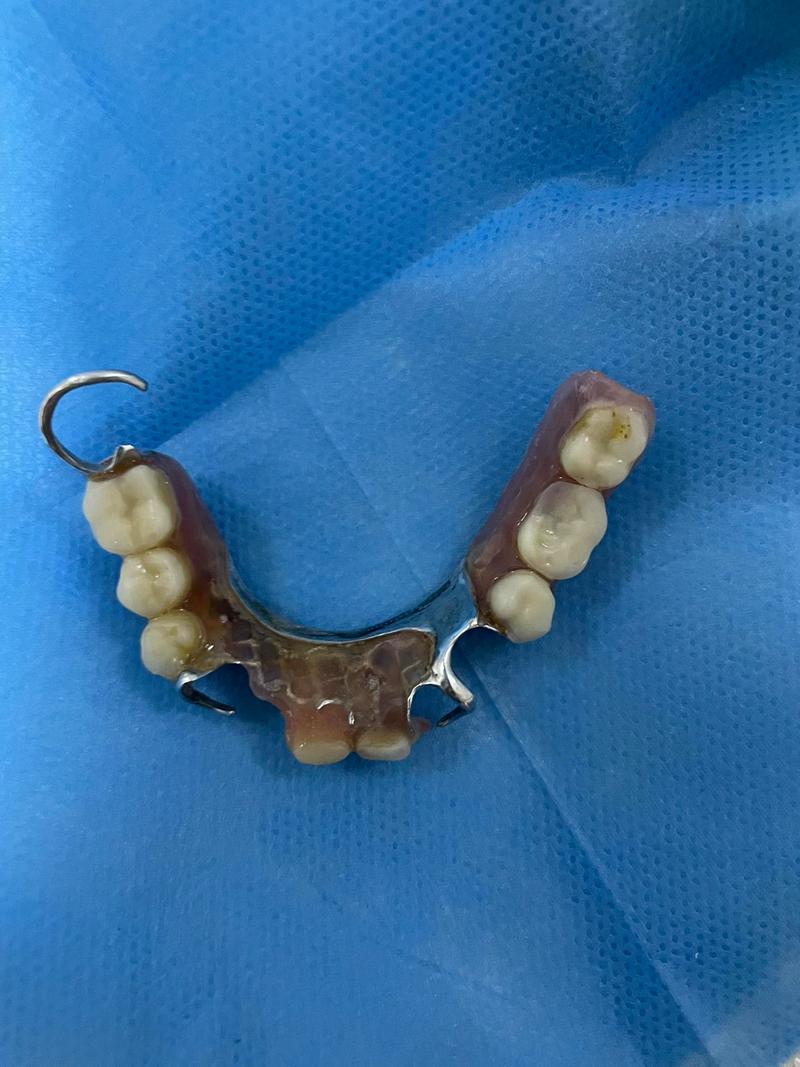 正畸种牙双料活动是什么?优惠如何参与?-图1 正畸种牙双料活动是什么?优惠如何参与?-图1