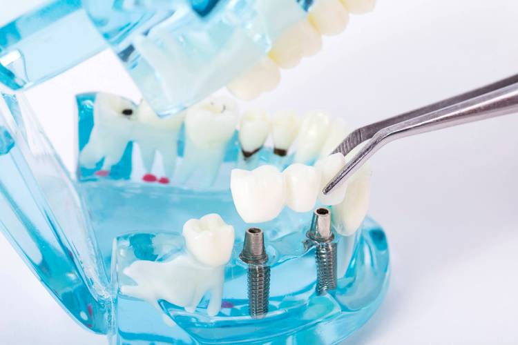 种牙材料有哪些？不同材质有何区别？-图3