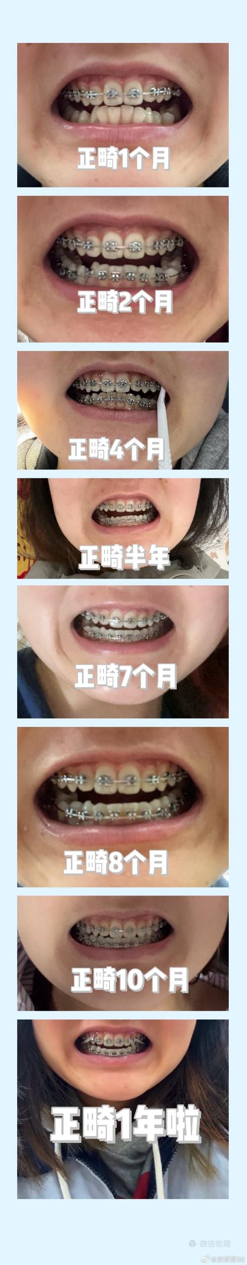 正畸哪个阶段牙齿变化最明显?-图3 正畸哪个阶段牙齿变化最明显?-图3