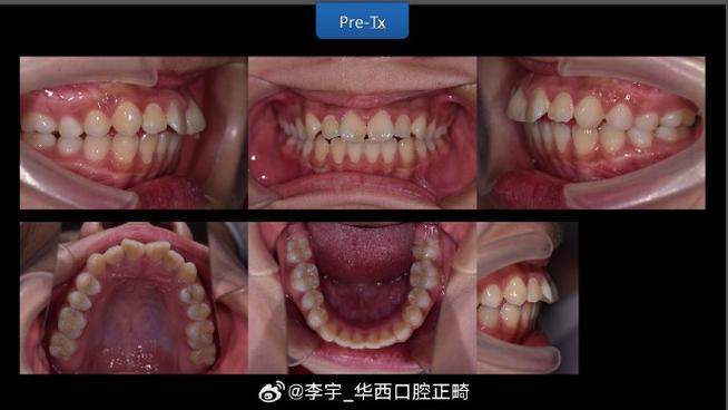 MBT正畸技术号称最先进,究竟先进在哪里?-图2 MBT正畸技术号称最先进,究竟先进在哪里?-图2