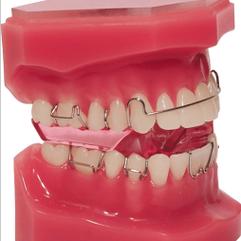 MBT正畸技术号称最先进,究竟先进在哪里?-图3 MBT正畸技术号称最先进,究竟先进在哪里?-图3