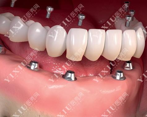 珠海摩尔口腔种牙效果如何？价格透明吗？值得信赖吗？-图1