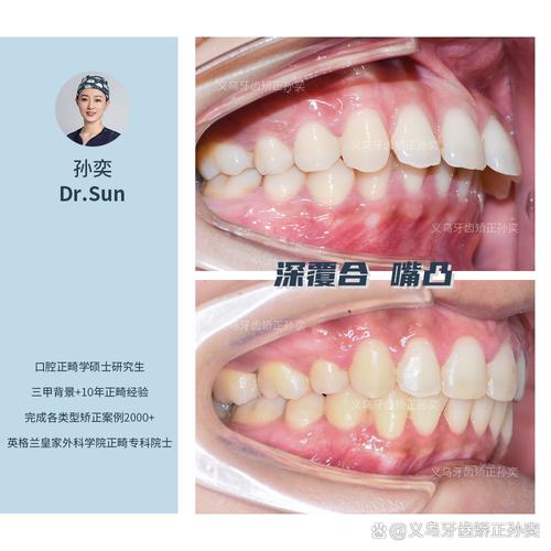 正畸后牙齿整齐了，怎么还是有点龅牙？-图3