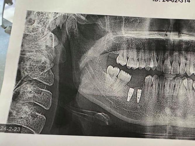 为什么越来越多人选瑞士ic种牙系列?-图3 为什么越来越多人选瑞士ic种牙系列?-图3
