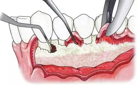 牙周病常见手术方法有哪些？哪种更适合患者？-图1