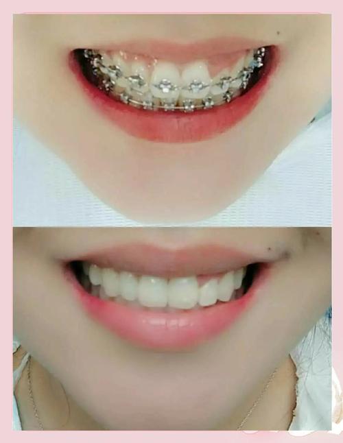 虎牙矫正最快方法是什么？哪种方式最快速？-图3
