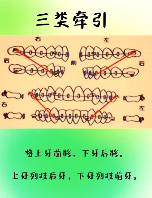 正畸滑动回收间隙的方法如何实现精准间隙控制？-图2