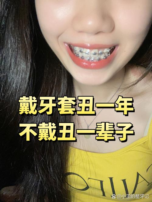 不带牙套整牙方法-图2