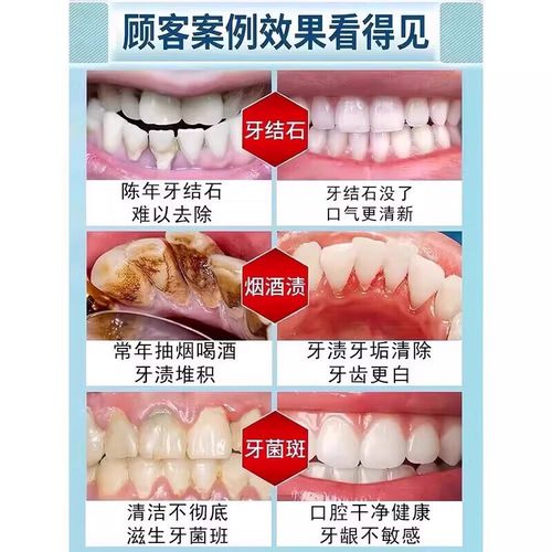 如何有效去除牙齿烟渍?有哪些实用方法?-图2 如何有效去除牙齿烟渍?有哪些实用方法?-图2