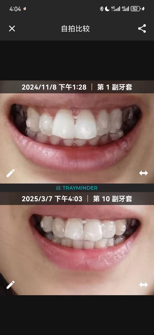 2025北口正畸日记里藏着哪些变美秘密？-图2