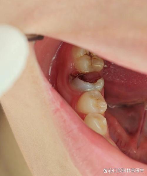 种牙后牙齿松动怎么回事？需要就医吗？-图1