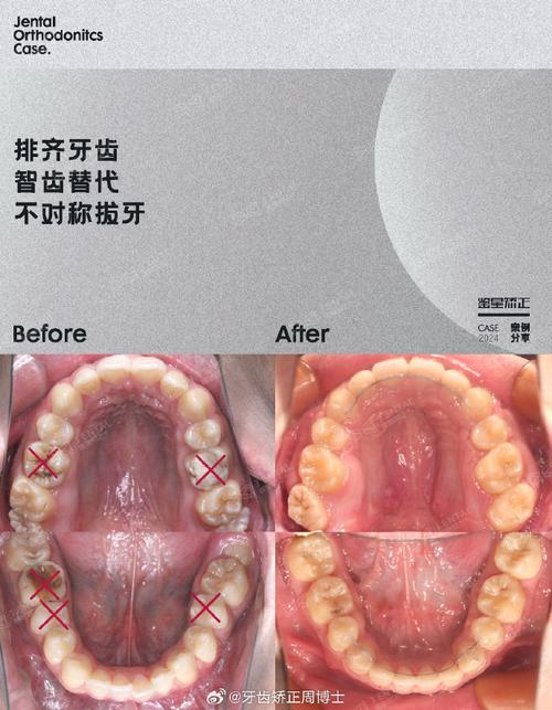 口腔正畸ANB是什么？测量有何意义？-图2