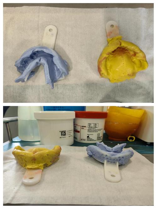 正畸口腔模型灌注寄存如何提升矫正效果？-图2