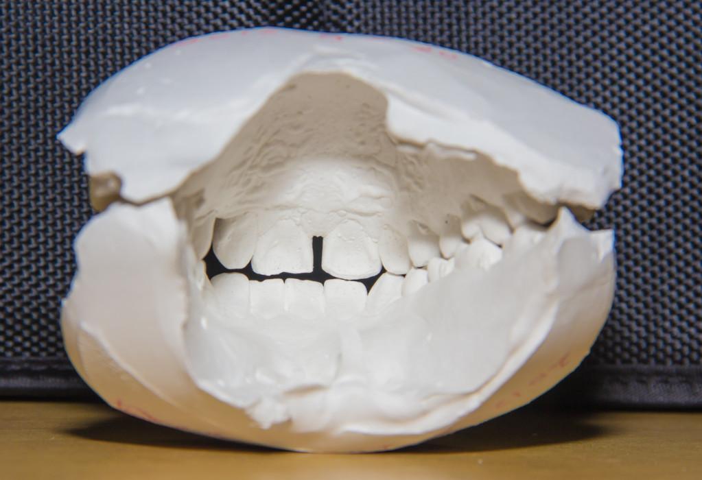 正畸口腔模型灌注寄存如何提升矫正效果？-图3