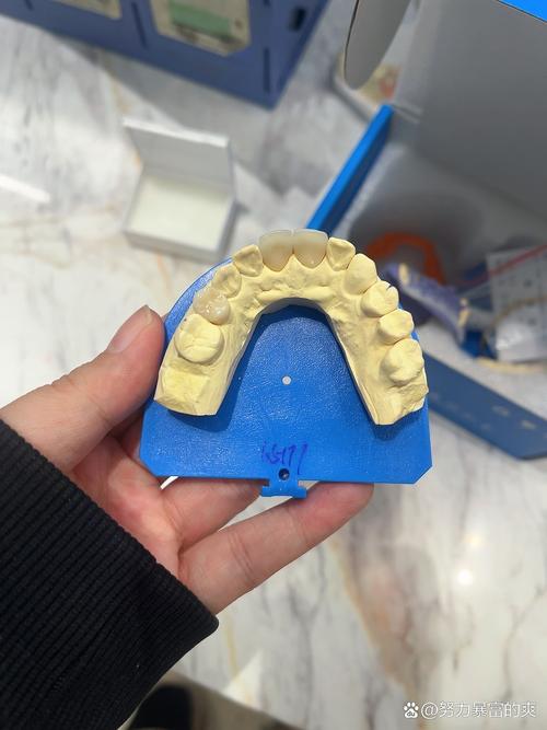 正畸口腔模型灌注寄存如何提升矫正效果？-图1