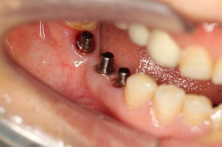 拔牙后很久没种牙会影响种牙成功率吗？-图2