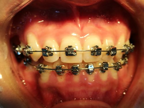 骨性反颌矫正有哪些科学有效的方法？-图2