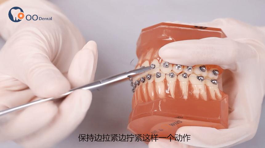 自锁托槽打开的具体操作方法有哪些？-图2