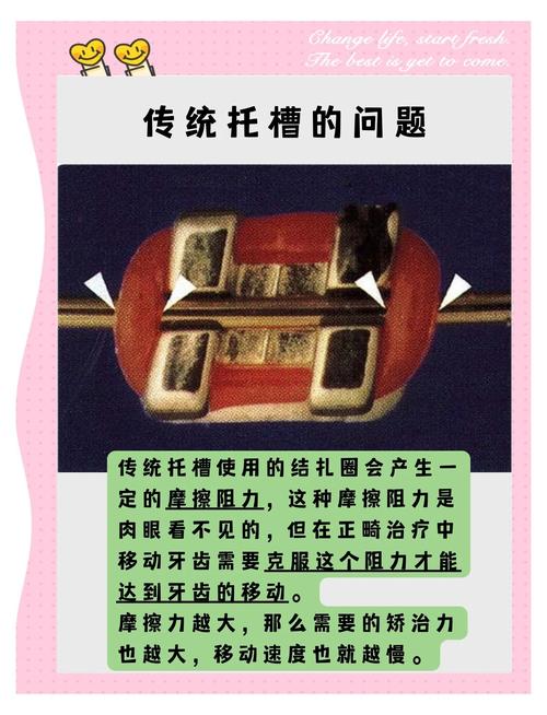 自锁托槽打开的具体操作方法有哪些？-图3