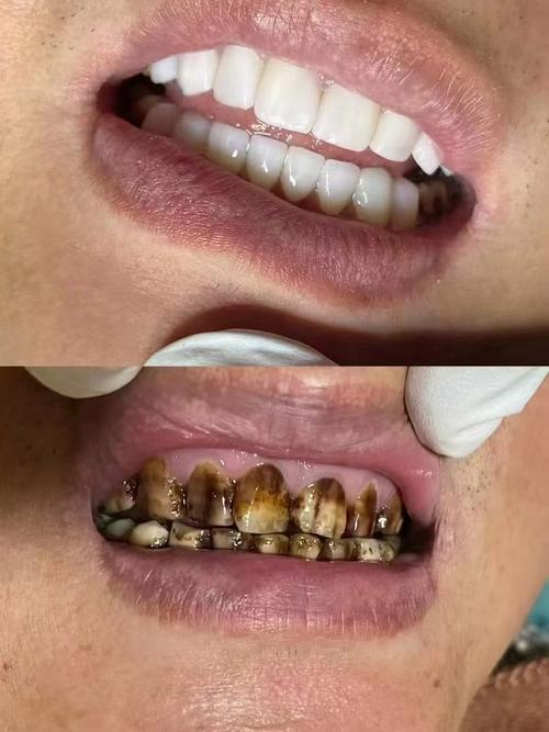 种牙手术后吸烟会影响种植成功率吗？-图2