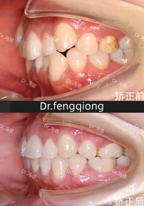 正畸个别牙高位错位是什么原因，如何处理？-图1