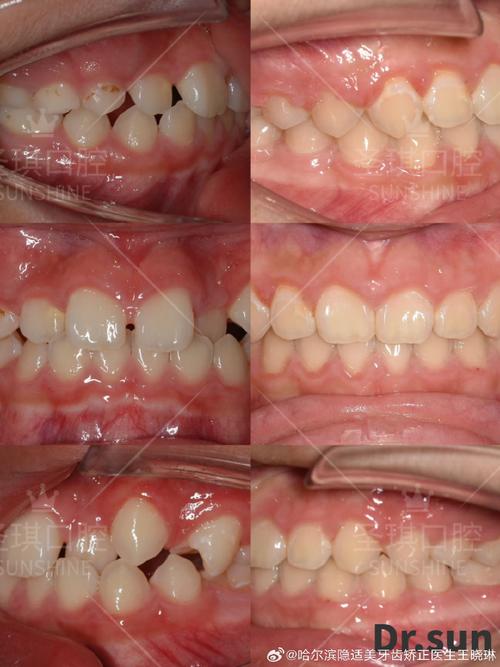 正畸个别牙高位错位是什么原因，如何处理？-图2