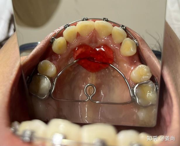 成都华美牙科牙齿正畸效果好不好？体验如何？-图1