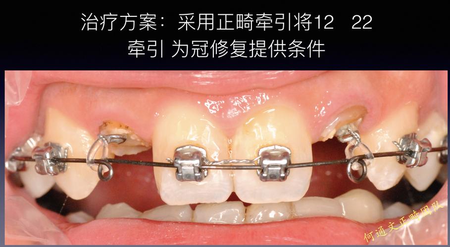 口腔残根正畸牵引视频如何牵引？-图2