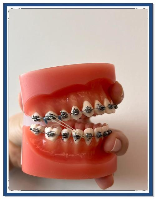 口腔残根正畸牵引视频如何牵引？-图3