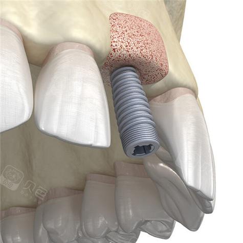 种牙植骨如何实现白色牙齿自然美观？-图1
