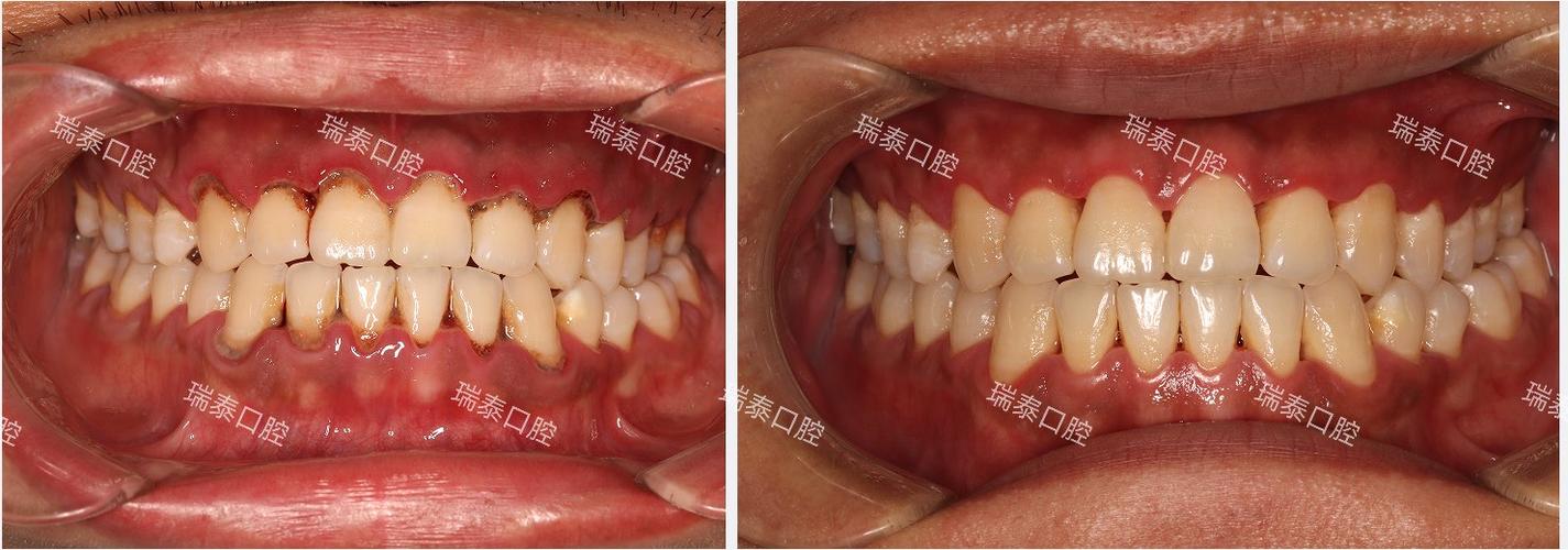 牙周病正畸综合治疗效果如何？-图1