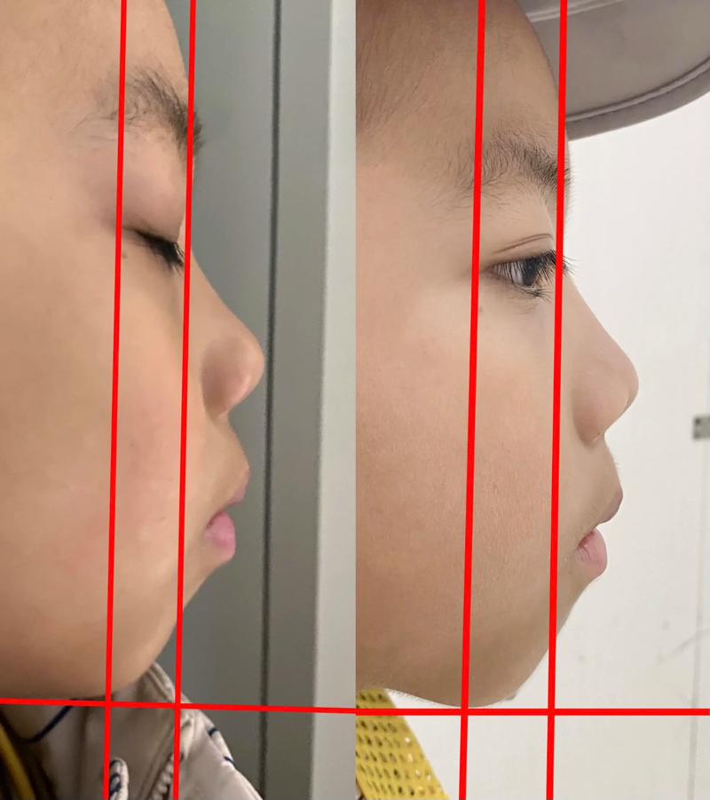 正畸侧面拍照为何需标准图片？效果对比关键依据在此？-图3