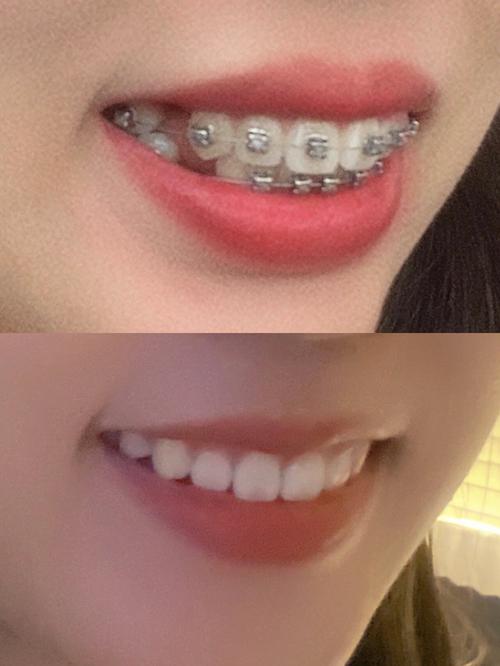 正畸侧面拍照为何需标准图片？效果对比关键依据在此？-图1