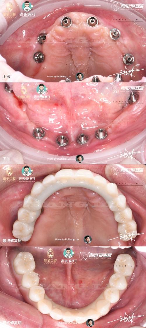 多个牙齿缺失种牙，如何选择更安心的方案？-图2