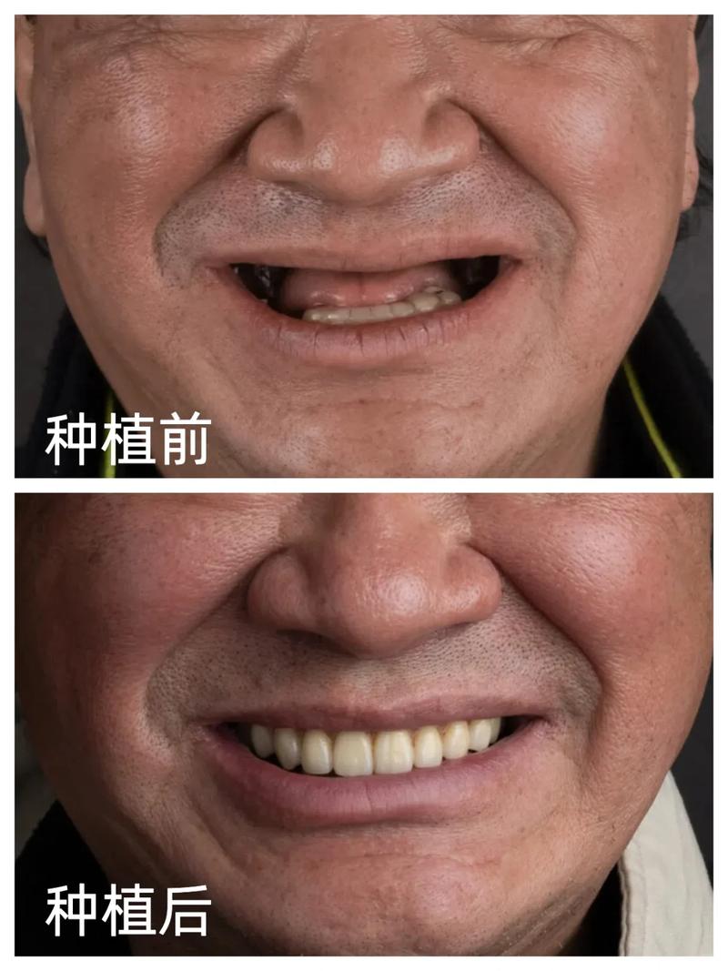 多个牙齿缺失种牙，如何选择更安心的方案？-图1