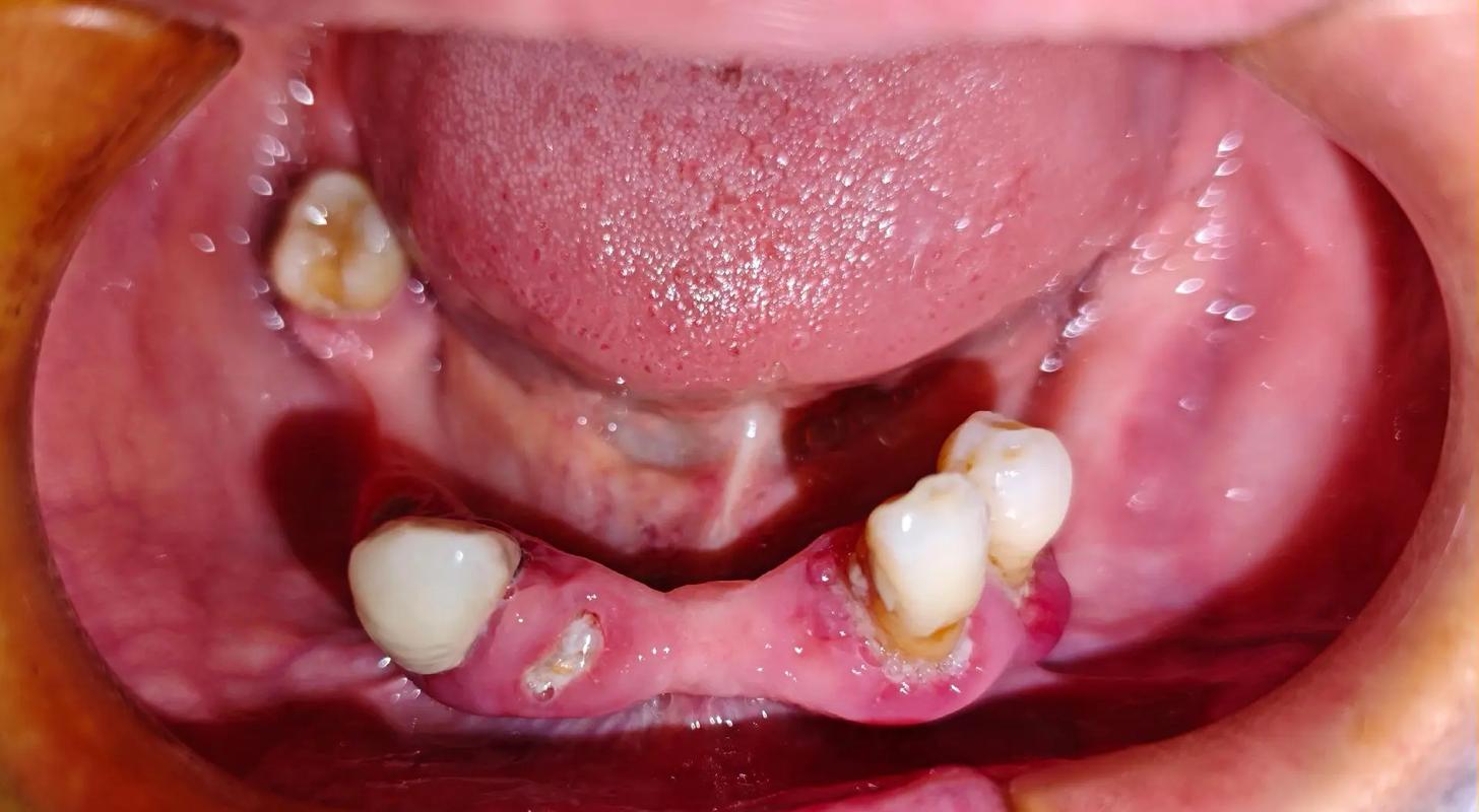 牙周炎下门牙种牙，如何才能顺利种牙呢？-图2