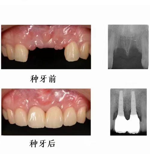 牙周炎下门牙种牙，如何才能顺利种牙呢？-图1