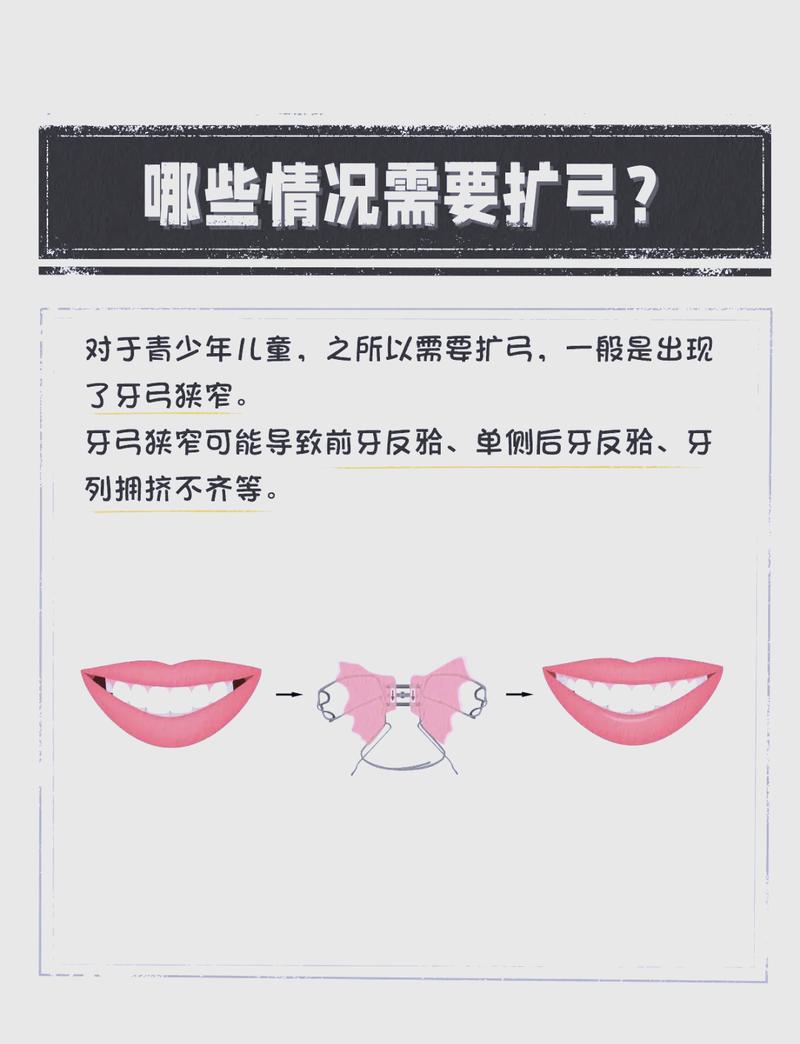 牙列拥挤矫治方法有哪些？哪种更适合自己？-图1