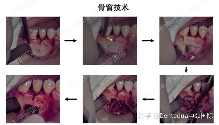 根尖囊肿有哪些有效治疗方法？-图2