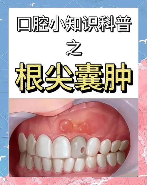 根尖囊肿有哪些有效治疗方法？-图1