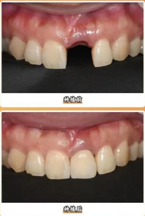 广州种牙去哪儿好？医院资质与医生技术怎么选？-图3