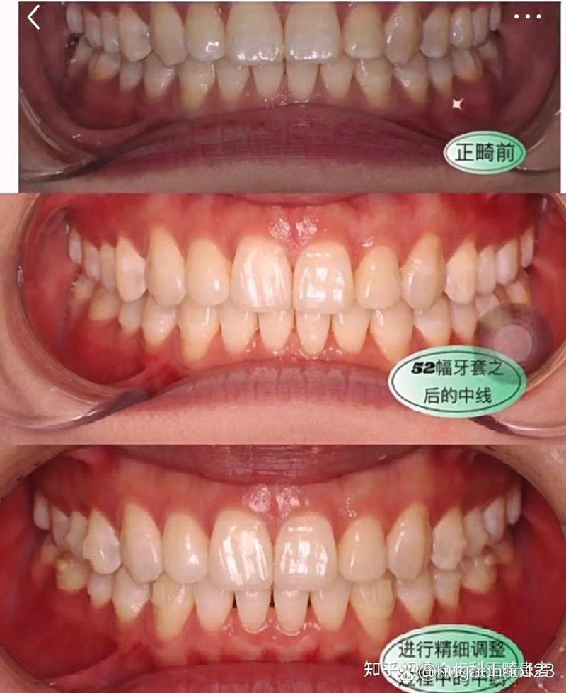 正畸手术失败案例频发，背后原因究竟何在？-图1