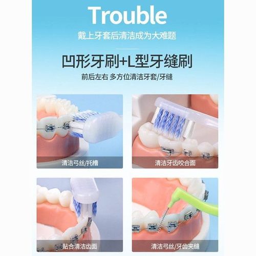 正畸托槽里面怎么清洁？内部死角怎么处理？-图1