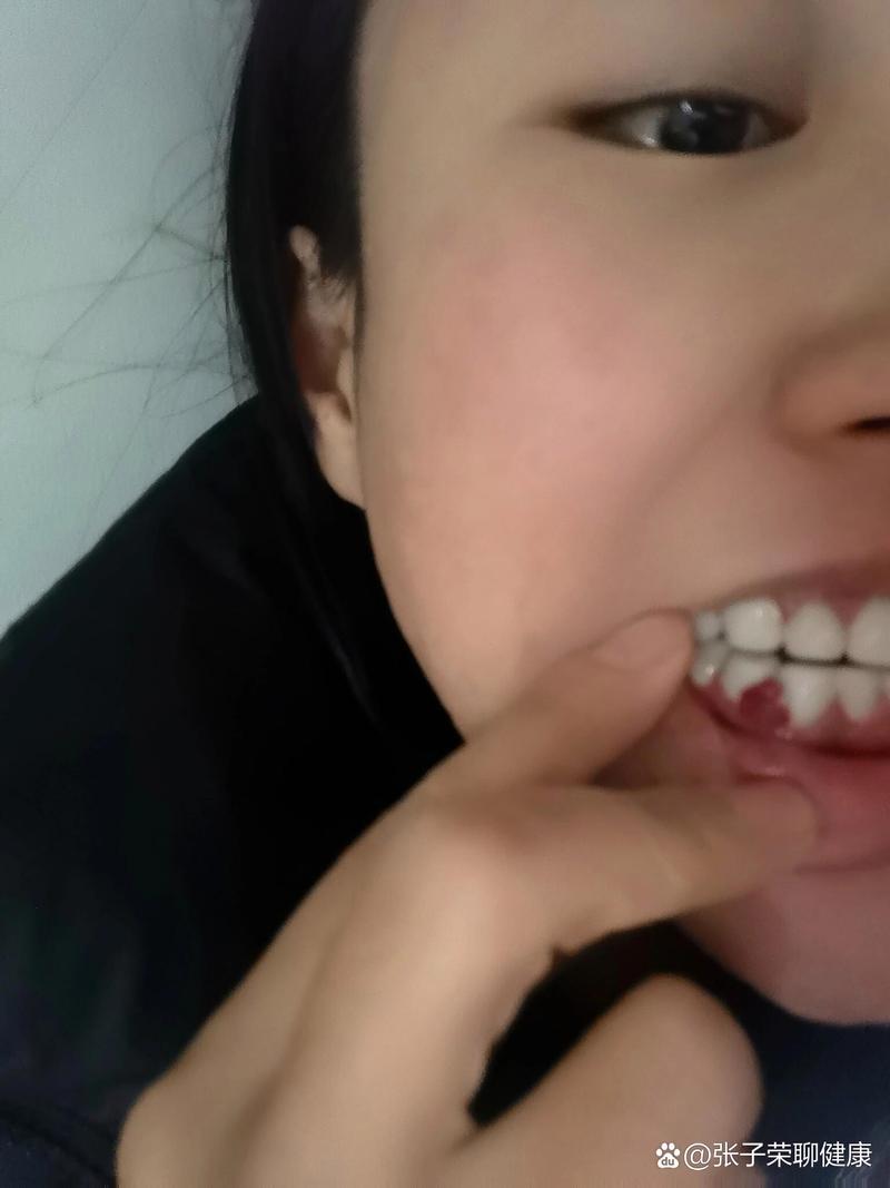 正畸期间牙龈红肿出血-图2