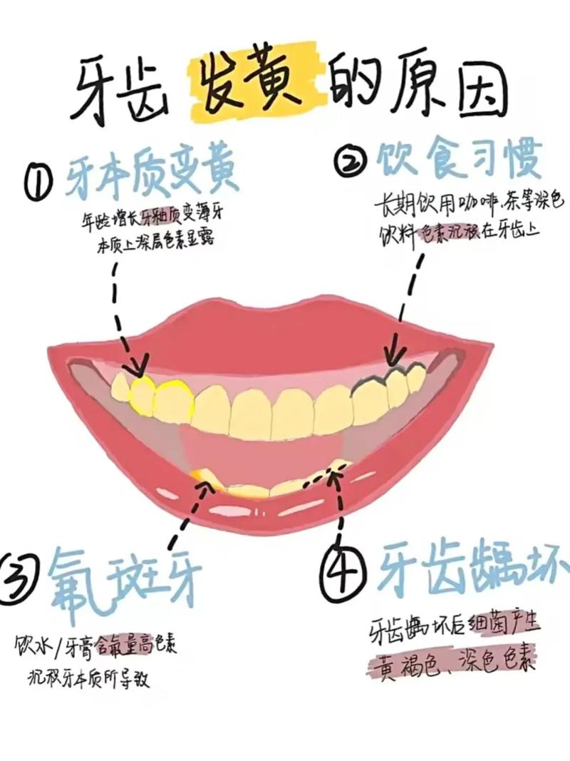 黄斑牙有哪些治疗方法？哪种效果又好又安全？-图2