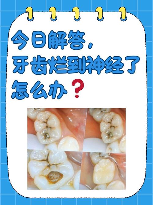 牙齿神经治疗方法有哪些？哪种更有效？-图2