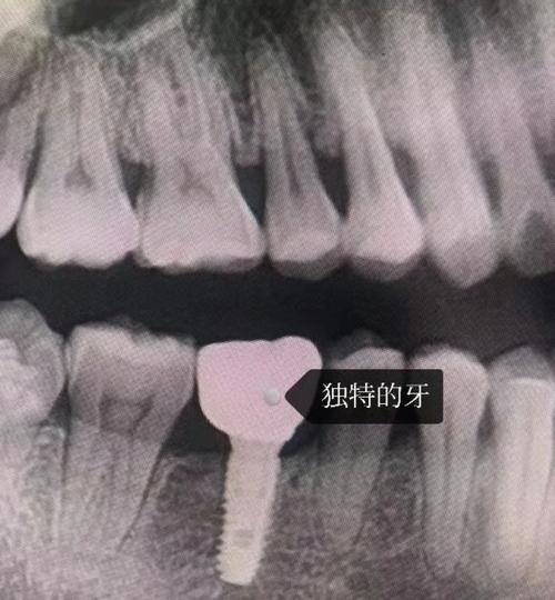 东莞种牙哪家好？医院医生怎么选？-图2